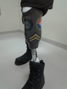 Army Vet Prosthetic