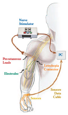 Illustration of nerve stimulator technology for people who have lost limbs
